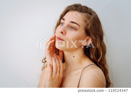 Portrait of beautiful young woman with inflammations on skin of her face. Medicine and cosmetology. Portrait of beautiful young woman with inflammations on skin of her face. Medicine and cosmetology. 119524347