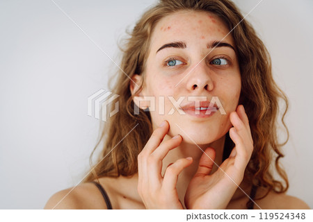 Portrait of beautiful young woman with inflammations on skin of her face. Medicine and cosmetology. Portrait of beautiful young woman with inflammations on skin of her face. Medicine and cosmetology. 119524348
