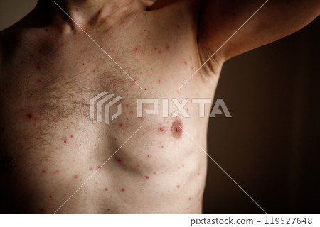 Red rash man's chest with varicella blisters, also known as chickenpox or monkeypox. 119527648