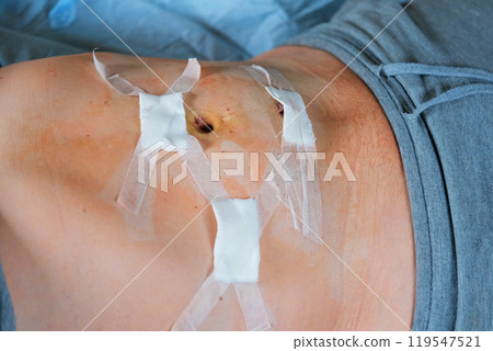 Hands of medic or nurse in blue gloves examining a fresh suture on a male stomach after laparoscopy surgical removal of appendicitis. Doctor examines of the patient. Man belly with medical stitches 119547521