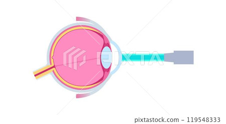 Lasik eye surgery Lasik eye surgery 119548333