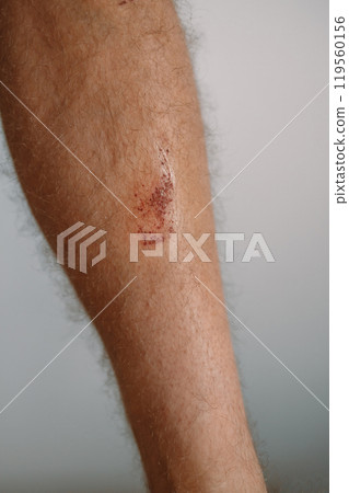 Skin abrasion on the leg. Deep skratches on the skin with broises on the childs knee. Wunds, skratches 119560156