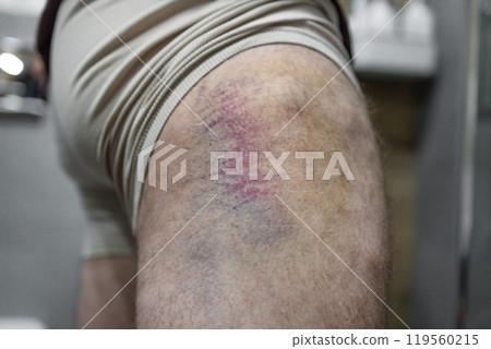 Thigh Injury from a collision, impact or fall, bruised man leg. Injury.Huge yellow-blue bruise with an abrasion on the thigh 119560215