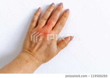 female hand with pigment spots on skin, swollen finger from insect bite female hand with pigment spots on skin, swollen finger from insect bite 119568260