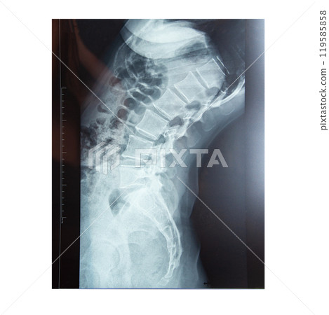 Medical x-ray of the spine body isolated on the white background Medical x-ray of the spine body isolated on the white background 119585858