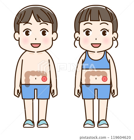 Artificial anus, stoma, colon, child, illustration Artificial anus, stoma, colon, child, illustration 119604620