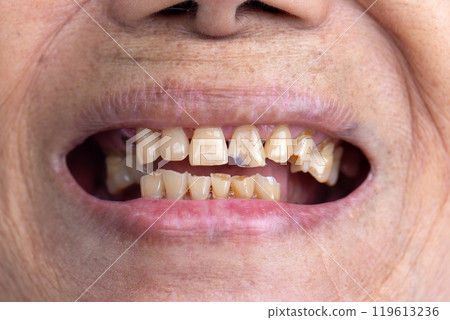 Attrition tooth due to interaction with other teeth in elderly woman. 119613236