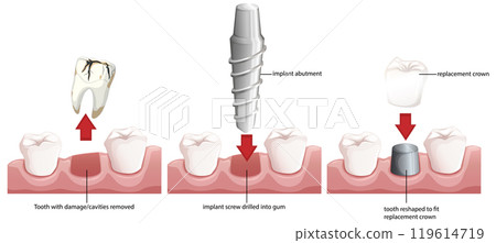 Dental Implant Procedure Illustration Dental Implant Procedure Illustration 119614719