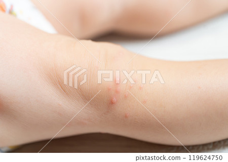 One-year-old boy with hand, foot and mouth disease 119624750