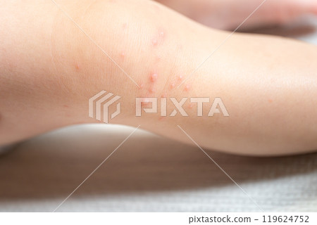 One-year-old boy with hand, foot and mouth disease 119624752