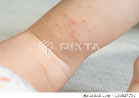 One-year-old boy with hand, foot and mouth disease 119624753