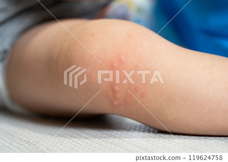 One-year-old boy with hand, foot and mouth disease One-year-old boy with hand, foot and mouth disease 119624758