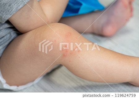One-year-old boy with hand, foot and mouth disease One-year-old boy with hand, foot and mouth disease 119624759