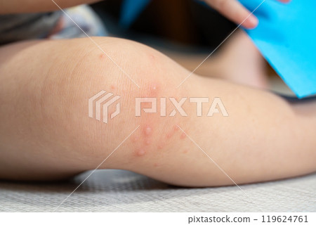 One-year-old boy with hand, foot and mouth disease One-year-old boy with hand, foot and mouth disease 119624761