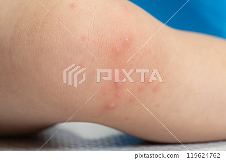 One-year-old boy with hand, foot and mouth disease 119624762