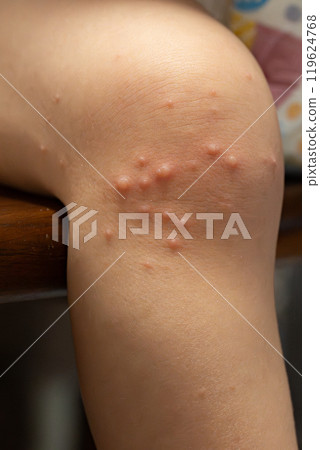 一歲男童患手足口病 一歲男童患手足口病 119624768