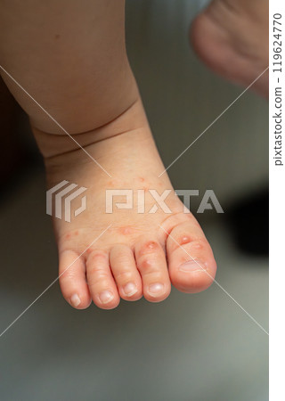One-year-old boy with hand, foot and mouth disease 119624770
