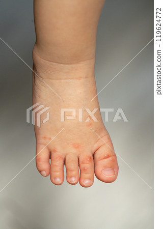 One-year-old boy with hand, foot and mouth disease 119624772