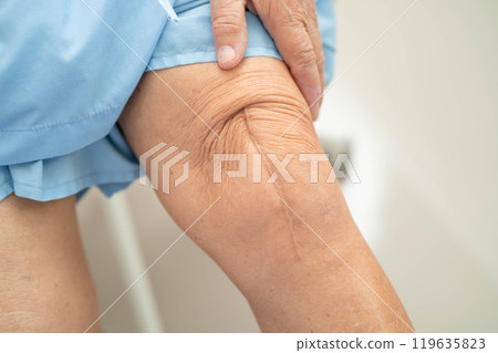 Asian elderly woman patient with scar knee replacement surgery in hospital. Asian elderly woman patient with scar knee replacement surgery in hospital. 119635823