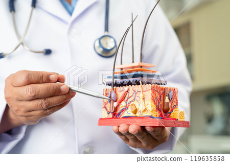 Hair transplant, Asian dermatologist doctor holding skin structure anatomy model for treatment in hospital. 119635858