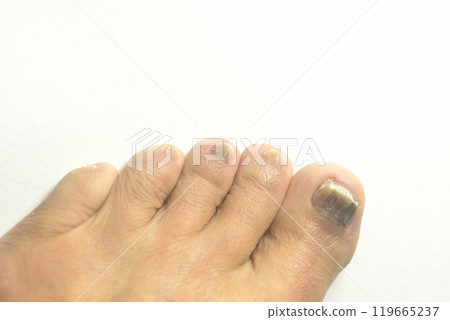 Close-up of toenail fungus 119665237