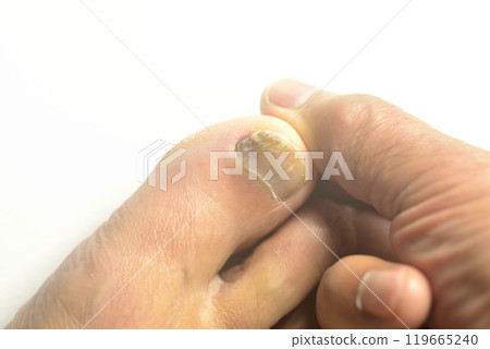 趾甲真菌特寫 趾甲真菌特寫 119665240