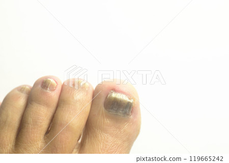 趾甲真菌特寫 119665242