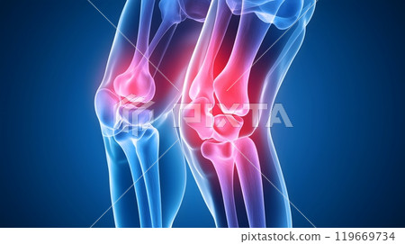 3D Illustration of Human Knee Joint with Inflammation and Pain Highlight_2 3D Illustration of Human Knee Joint with Inflammation and Pain Highlight_2 119669734