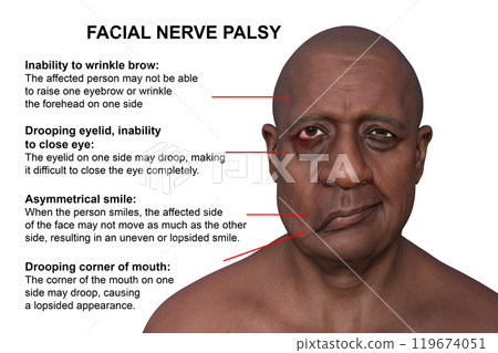 Facial palsy in a man, photorealistic 3D illustration Facial palsy in a man, photorealistic 3D illustration 119674051