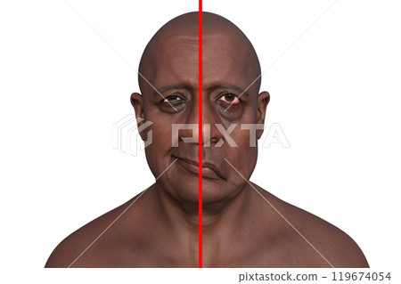 Facial palsy in a man, photorealistic 3D illustration Facial palsy in a man, photorealistic 3D illustration 119674054