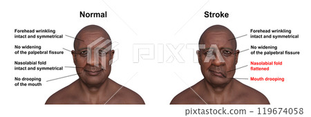 A man showing left-side stroke, 3D illustration 119674058