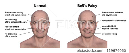 Facial palsy in a man, photorealistic 3D illustration Facial palsy in a man, photorealistic 3D illustration 119674060