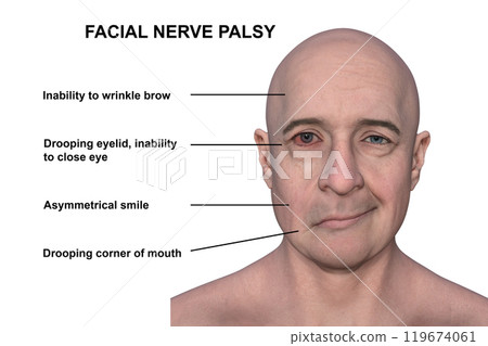 Facial palsy in a man, photorealistic 3D illustration Facial palsy in a man, photorealistic 3D illustration 119674061