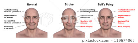 A man showing left-side stroke and facial palsy, 3D illustration A man showing left-side stroke and facial palsy, 3D illustration 119674063