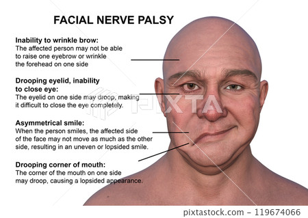 Facial palsy in a man, photorealistic 3D illustration 119674066