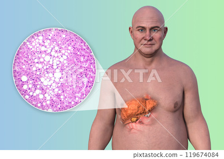 Fatty liver in a man, 3D illustration Fatty liver in a man, 3D illustration 119674084