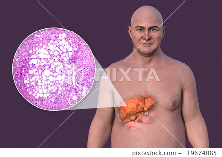 Fatty liver in a man, 3D illustration 119674085