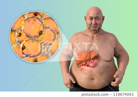 Fatty liver in a man, 3D illustration Fatty liver in a man, 3D illustration 119674091