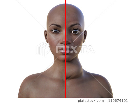 An African woman with normal and enlarged thyroid with exophthalmos, 3D illustration 119674101