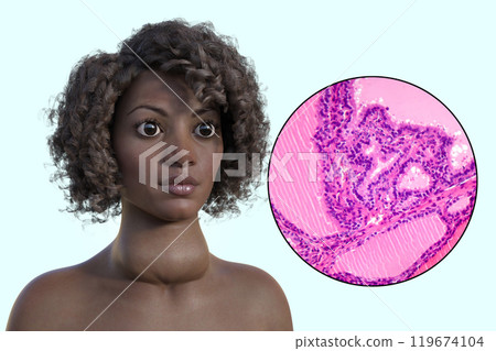An African woman with enlarged thyroid with exophthalmos, 3D illustration 119674104