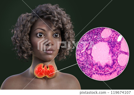 An African woman with enlarged thyroid with exophthalmos, 3D illustration An African woman with enlarged thyroid with exophthalmos, 3D illustration 119674107