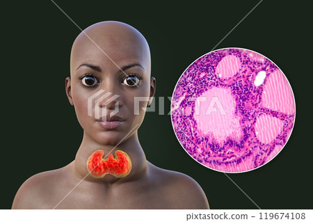 An African woman with enlarged thyroid with exophthalmos, 3D illustration An African woman with enlarged thyroid with exophthalmos, 3D illustration 119674108