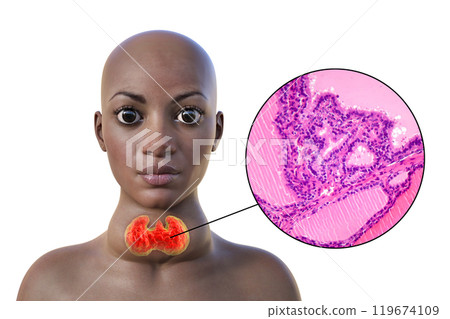 An African woman with enlarged thyroid with exophthalmos, 3D illustration 119674109