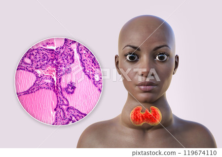 An African woman with enlarged thyroid with exophthalmos, 3D illustration An African woman with enlarged thyroid with exophthalmos, 3D illustration 119674110