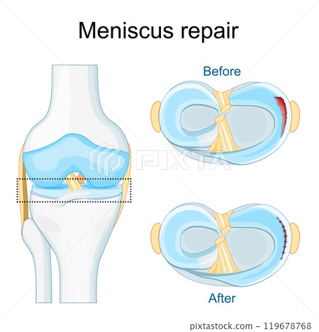Meniscus injury. Close-up of knee joint. Meniscus injury. Close-up of knee joint. 119678768