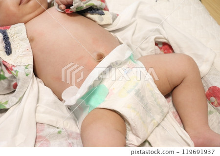 寶寶肚臍圖片-大疝氣 119691937