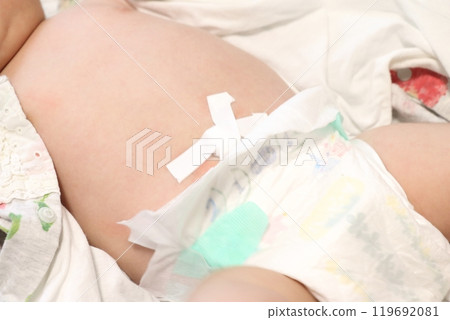 Baby belly button image, belly button protuberance, groin hernia Baby belly button image, belly button protuberance, groin hernia 119692081