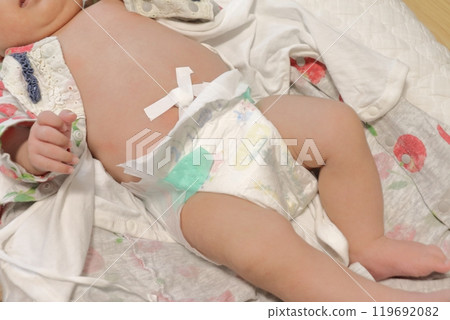 Baby belly button image, belly button protuberance, groin hernia 119692082