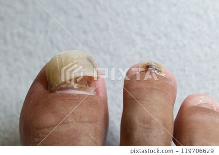 Detached big toe nail Detached big toe nail 119706629