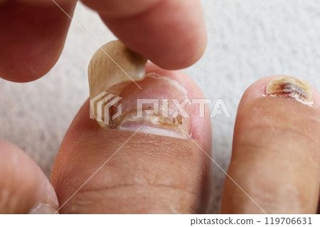 Detached big toe nail 119706631